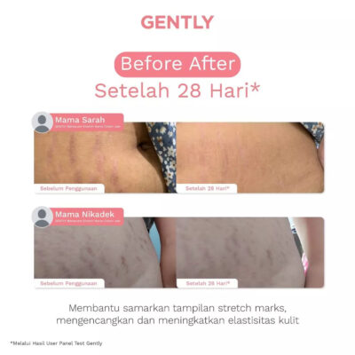 GENTLY Mamacare Intensive Stretch Marks Cream | Complex Hydrating Formula 5X Natural Soothing Agent thumbnail 5