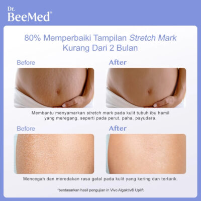 Dr.BeeMed Stretch Mark Cream 100g - Krim Menyamarkan Stretch Mark Ibu Hamil & Menyusui [BPOM] thumbnail 3